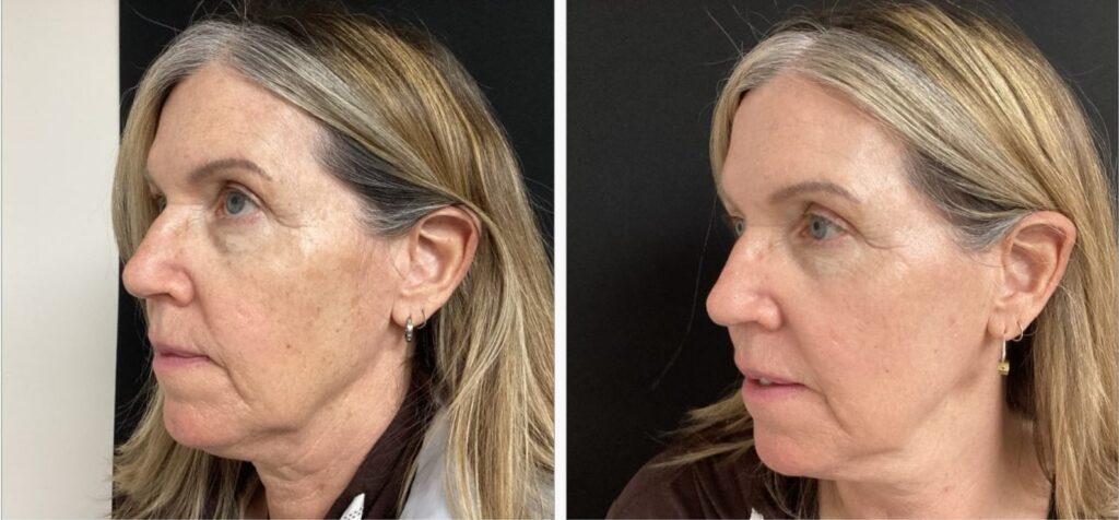 Before and after CO2 laser skin resurfacing in Bend, OR