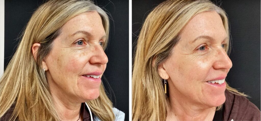 Before and after CO2 laser skin resurfacing in Bend, OR