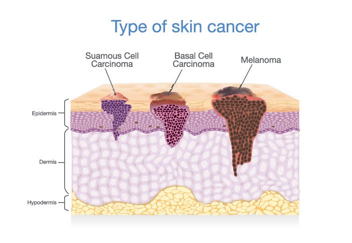 Illustration of types of skin cancer including carcinoma and melanoma