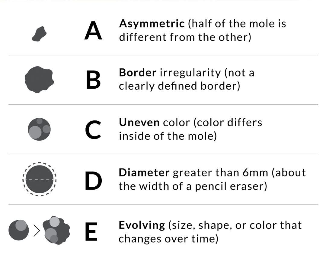 Illustration of t he ABCDE's of recognizing skin cancer